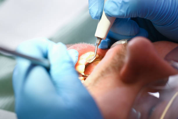Best Emergency Wisdom Teeth Removal in Bacliff, TX