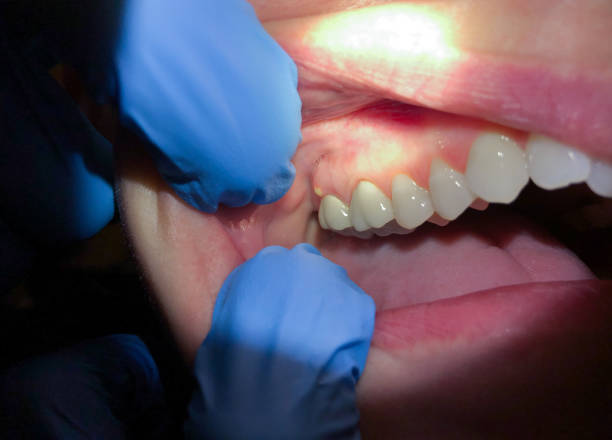 Best Emergency Tooth Extraction in Bacliff, TX