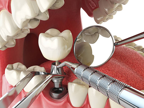 Best Emergency Treatment for Dental Infections or Abscesses in Bacliff, TX